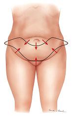 high superior tension tummy tuck abroad